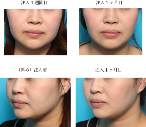 脂肪溶解注射 美容整形 美容外科ならヴェリテクリニック 公式 東京 名古屋 大阪