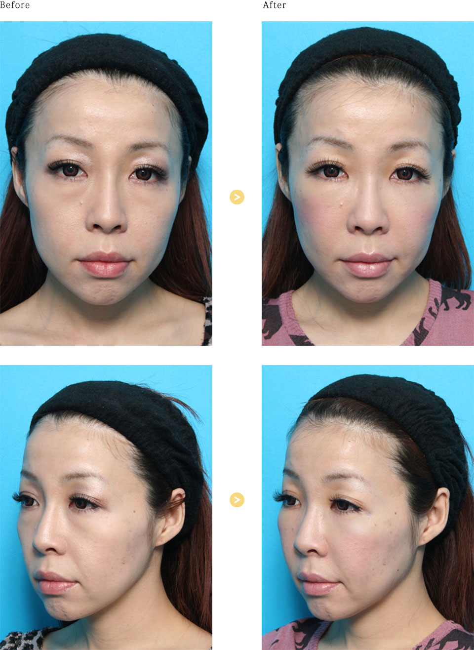 ドールチーク 頬形成 美容整形 美容外科のヴェリテクリニック 公式 東京 名古屋 大阪
