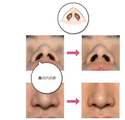 鼻翼縮小術パート2 美容整形 美容外科のヴェリテクリニック 公式 東京 名古屋 大阪