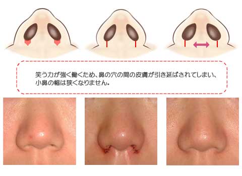 鼻翼縮小術パート2 美容整形 美容外科のヴェリテクリニック 公式 東京 名古屋 大阪