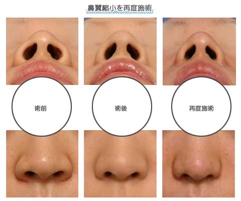 小さく 穴 鼻 の 方法 を する