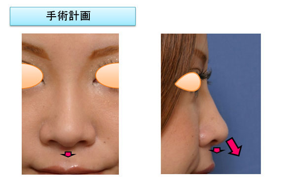 鼻中隔延長後の修正 ヴェリテクリニック 公式 東京 名古屋 大阪 美容整形 美容外科