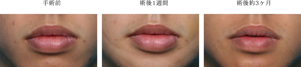 口唇縮小術 美容整形 美容外科ならヴェリテクリニック 公式 東京 名古屋 大阪