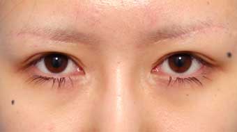 眉毛を持ち上げる手術 前額リフト 美容整形 美容外科のヴェリテクリニック 公式 東京 名古屋 大阪