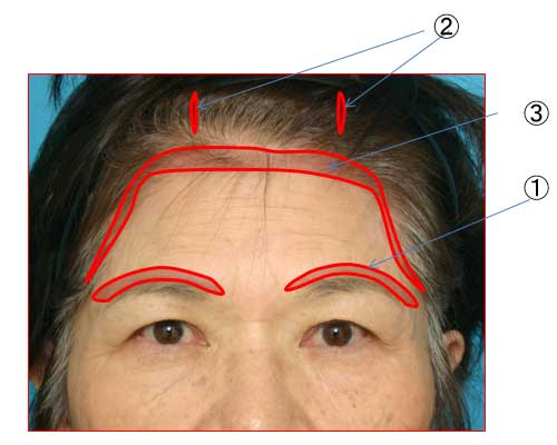 眉毛を持ち上げる手術 前額リフト について 美容整形 美容外科のヴェリテクリニック 公式 東京 名古屋 大阪