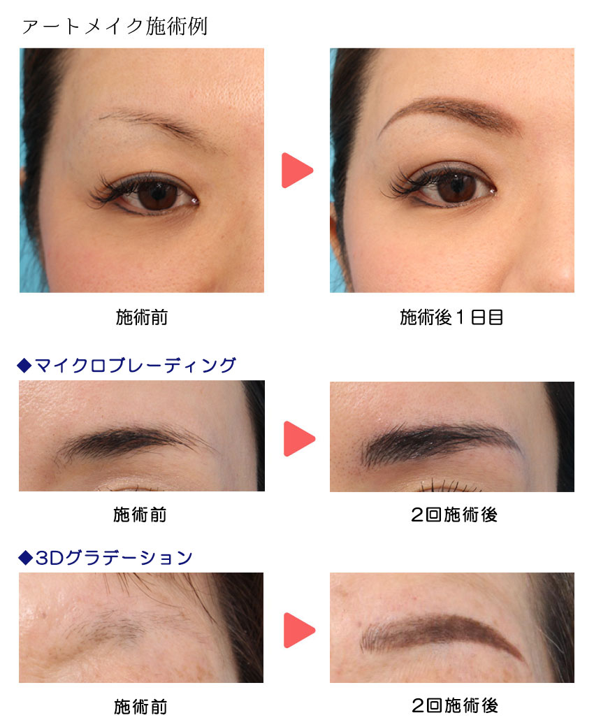 医療アートメイク 美容整形 美容外科のヴェリテクリニック 公式 東京 名古屋 大阪 医療アートメイク 美容整形 美容外科のヴェリテクリニック 公式 東京 名古屋 大阪