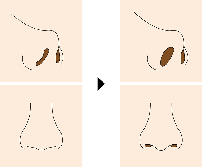 鼻孔縁挙上（切除）