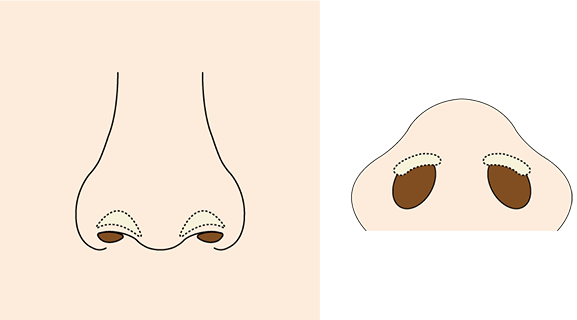 鼻孔縁形成術