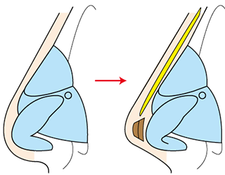 鼻尖形成術