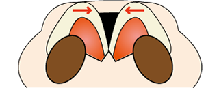 鼻尖縮小術