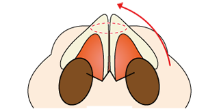 鼻尖縮小術