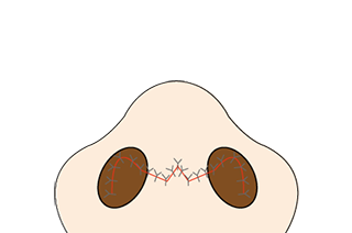 鼻尖縮小術
