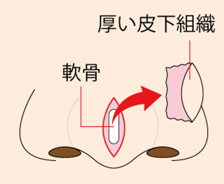 鼻尖縮小術