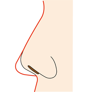 鼻中隔延長術