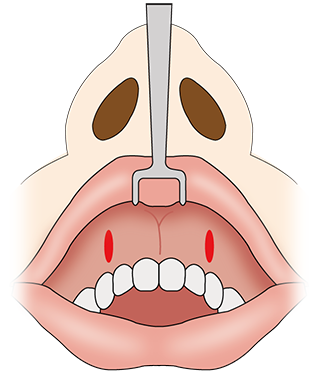 鼻翼 基部 プロテーゼ