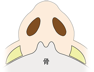 鼻翼基部プロテーゼ