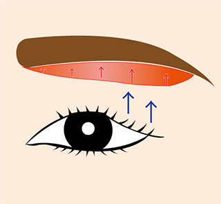 上眼瞼切開（上眼瞼リフト）