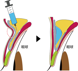 上眼瞼くぼみ