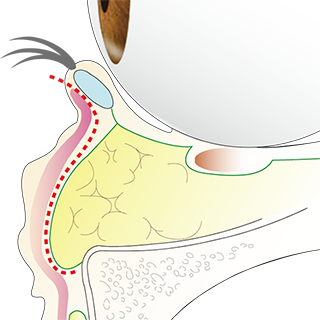 下眼瞼切開術