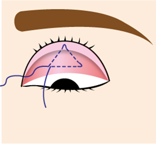 埋没式眼瞼下垂術