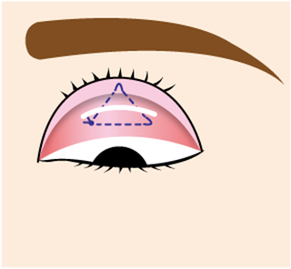 埋没式眼瞼下垂術