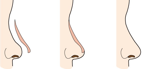 隆鼻術
