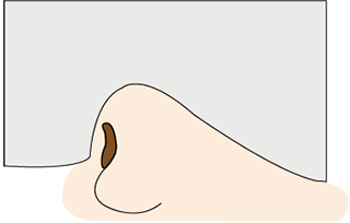隆鼻術