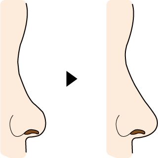 隆鼻術