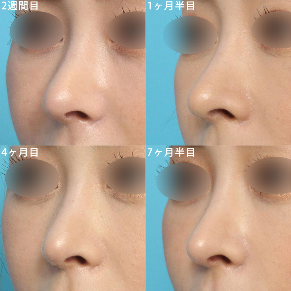 鼻中隔延長術と鼻尖縮小のビフォーアフターの経過画像