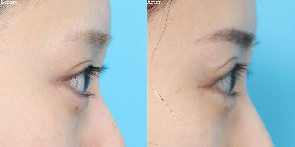 before_after