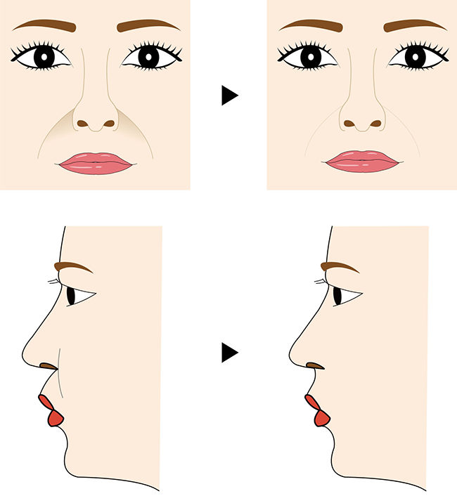 鼻翼基部プロテーゼ