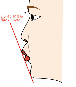 Eラインと鼻翼基部プロテーゼ