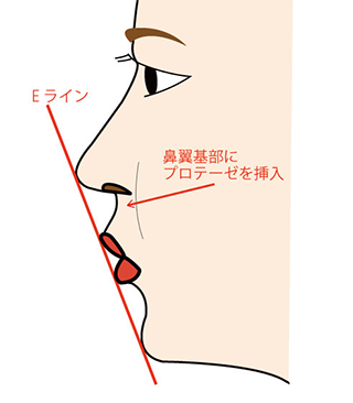 Eラインと鼻翼基部プロテーゼ