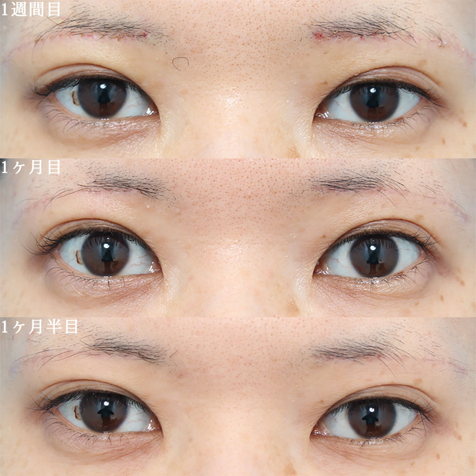 上眼瞼リフトのアフターの経過症例画像（正面）