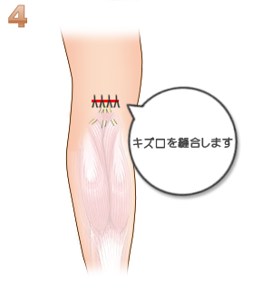 下腿部筋萎縮術
