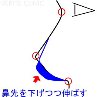 鼻先自体の位置も下げつつ、鼻柱を伸ばす