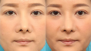 鼻翼縮小で小鼻の垂れ下がりを緩和し存在感のない小鼻へ