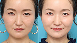 糸リフトでハリが出て、もたつきがない憧れの小顔へ