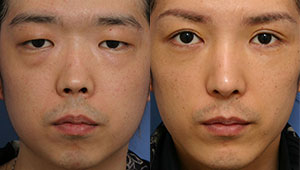 二重整形＋眼瞼下垂術で重い一重まぶたを綺麗な二重へ