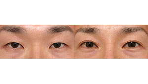 眼瞼下垂＋目頭切開＋目尻切開で重い一重まぶたを自然な二重へ