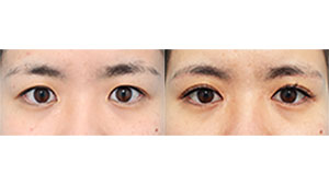 眉下切開と目頭切開で目元をすっきりさせ目力アップ