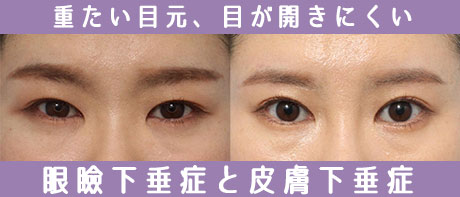 目の開きを改善する眼瞼下垂術と上眼瞼リフト術
