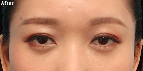 after