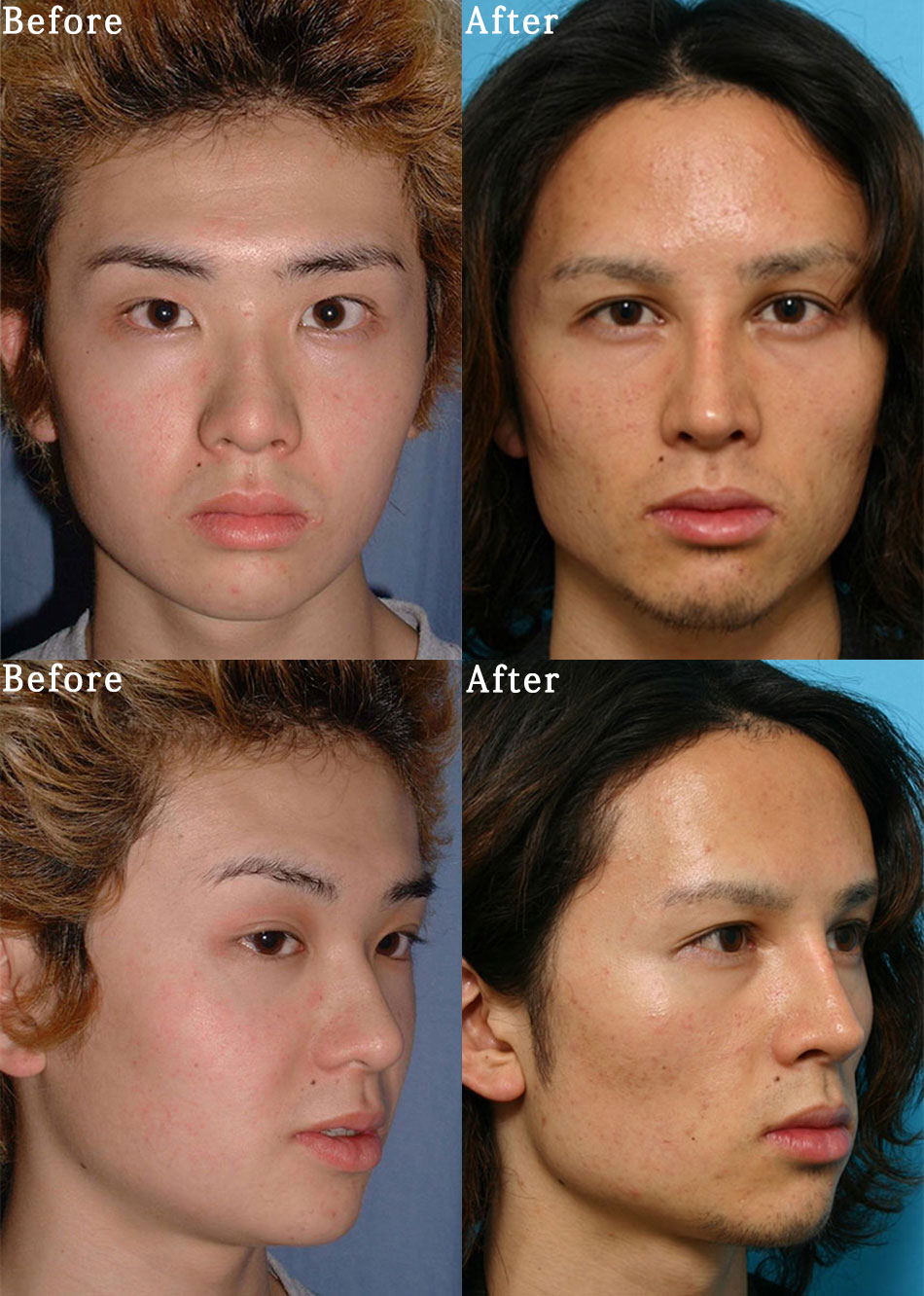 目元整形と鼻整形のビフォーアフターの症例画像