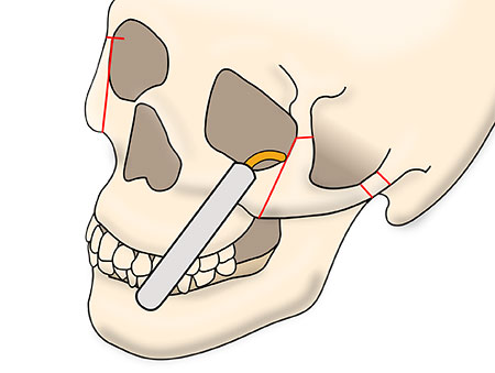 頬骨セットバックの術式