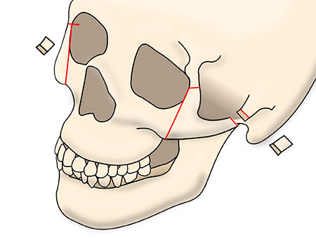 頬骨セットバックの術式