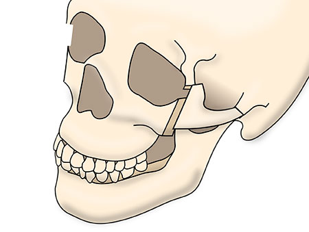 頬骨セットバックの術式