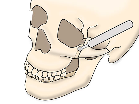 頬骨セットバックの術式