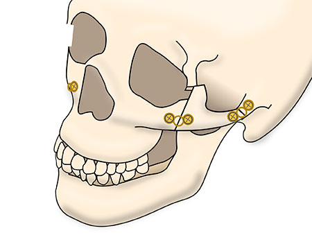 頬骨セットバックの術式
