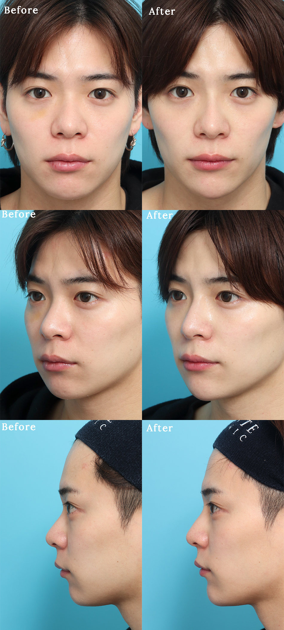 ヒアルロン酸注入の症例写真